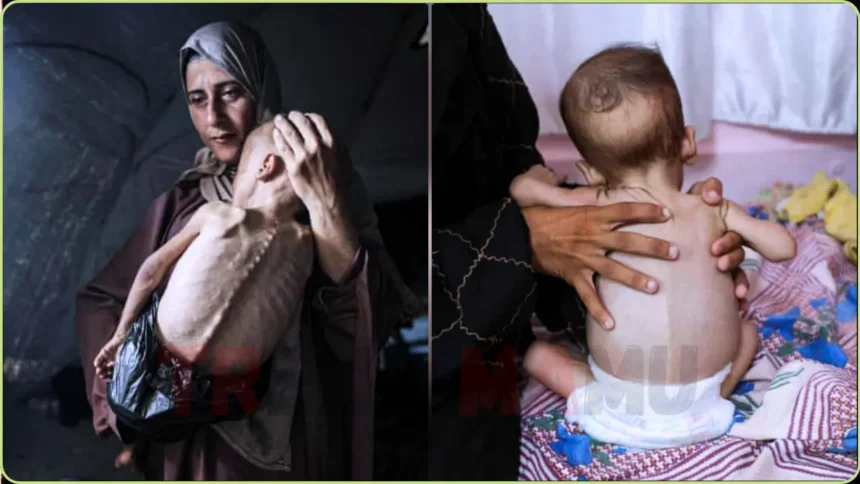 Starvation Crisis in Gaza Hospital Wards